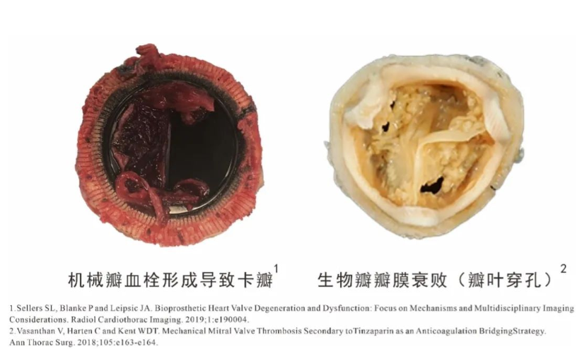 高分子瓣膜企業(yè)心銳醫(yī)療完成超千萬(wàn)元天使輪融資，北極光創(chuàng)投獨(dú)家投資